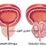 الأسبرين لجنب سرطان البروستات