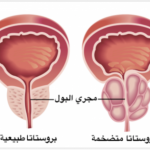 بروستات : هل يمنع تناول الأسبرين الإصابة بسرطان قاتل